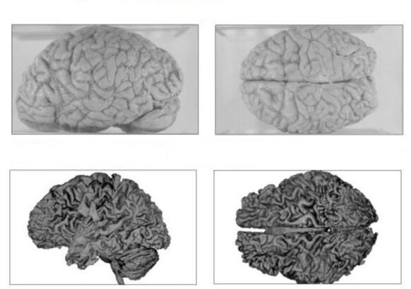 The brain of a healthy person (top) and the brain of an alcoholic with irreversible consequences (bottom)