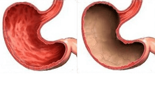 Ulcer, gastritis, cancer and other pathologies of the stomach (right), the occurrence of which is caused by alcohol